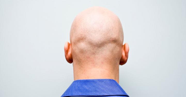 Calling a man 'bald' is considered sexual harassment, tribunal r