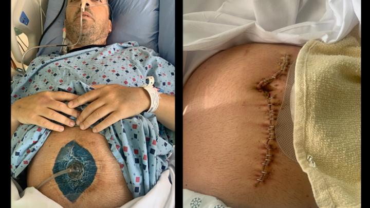 Photos Show Horrific Covid Vaccine Injury: Man Loses 6 Feet of S